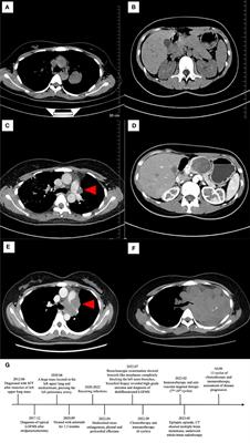Case report: Primary pulmonary low grade fibromyxoid sarcoma progressing to dedifferentiation: probably due to TP53 driver mutation